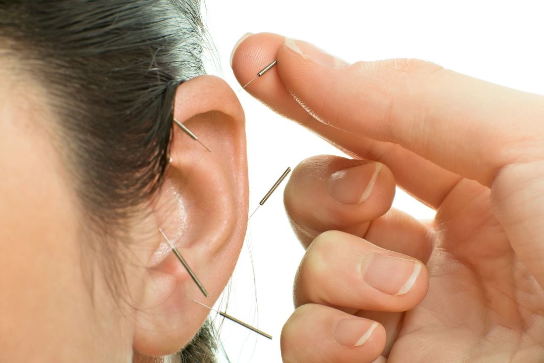 Acupuncture in ear